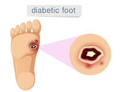 Diabetic Foot Ulcers